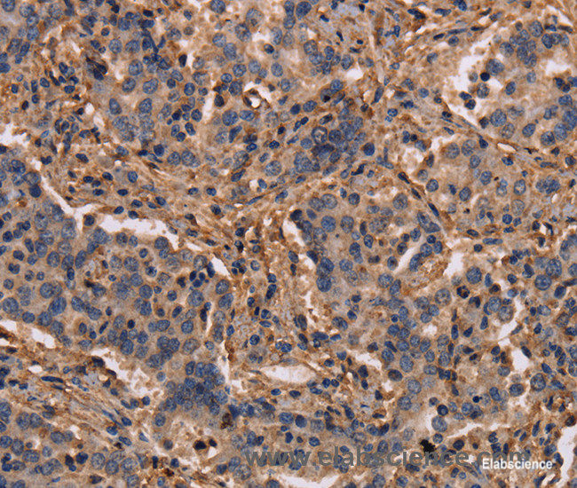 Immunohistochemistry of paraffin-embedded Human liver cancer tissue using MAP1LC3C Polyclonal Antibody at dilution 1:40