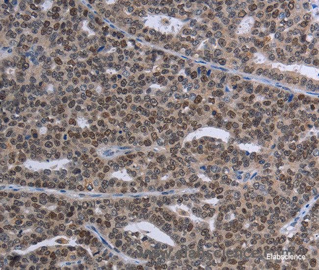 Immunohistochemistry of paraffin-embedded Human ovarian cancer tissue using MAGEC1 Polyclonal Antibody at dilution 1:30