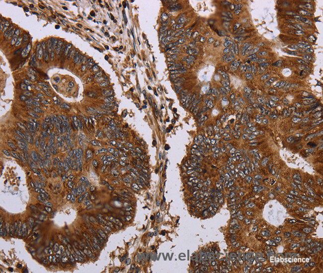 Immunohistochemistry of paraffin-embedded Human colon cancer tissue using MAGEC2 Polyclonal Antibody at dilution 1:40