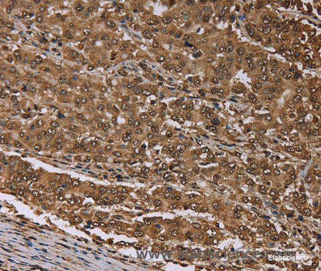 Immunohistochemistry of paraffin-embedded Human liver cancer tissue using MEIS1 Polyclonal Antibody at dilution 1:30
