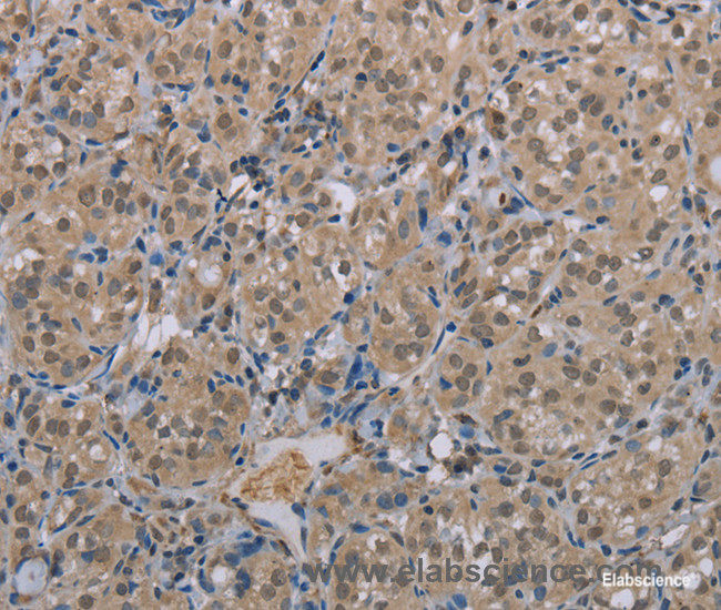 Immunohistochemistry of paraffin-embedded Human thyroid cancer tissue using MGLL Polyclonal Antibody at dilution 1:40