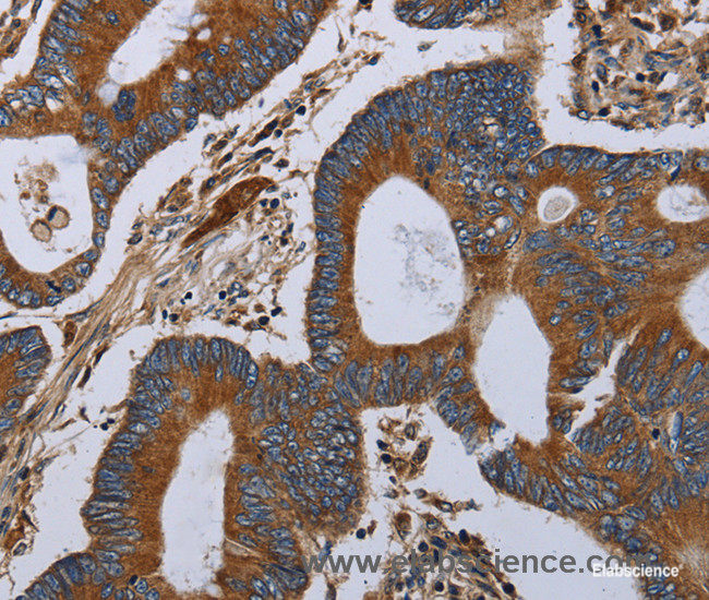 Immunohistochemistry of paraffin-embedded Human colon cancer tissue using MT-ND6 Polyclonal Antibody at dilution 1:40