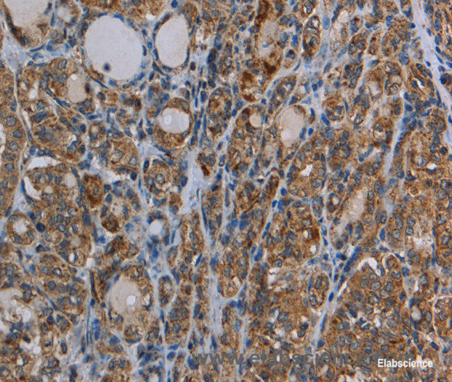 Immunohistochemistry of paraffin-embedded Human thyroid cancer tissue using MYO7A Polyclonal Antibody at dilution 1:30