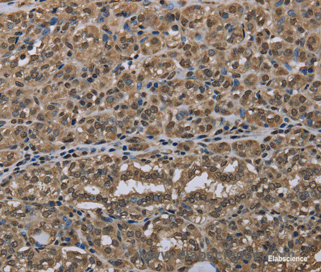 Immunohistochemistry of paraffin-embedded Human thyroid cancer tissue using NLRP6 Polyclonal Antibody at dilution 1:50