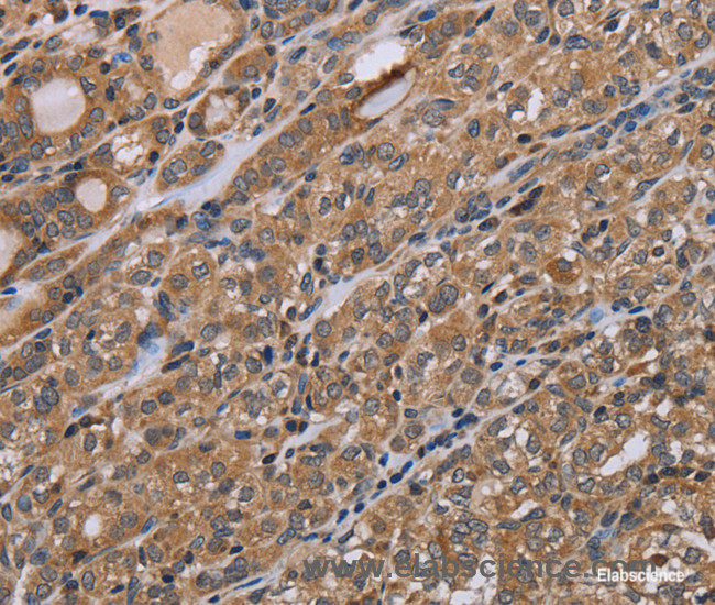 Immunohistochemistry of paraffin-embedded Human thyroid cancer tissue using NAA25 Polyclonal Antibody at dilution 1:40