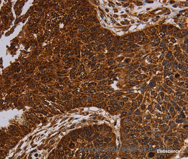 Immunohistochemistry of paraffin-embedded Human lung cancer tissue using NDUFAB1 Polyclonal Antibody at dilution 1:50