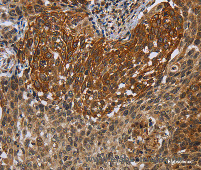 Immunohistochemistry of paraffin-embedded Human cervical cancer tissue using UHRF2 Polyclonal Antibody at dilution 1:40