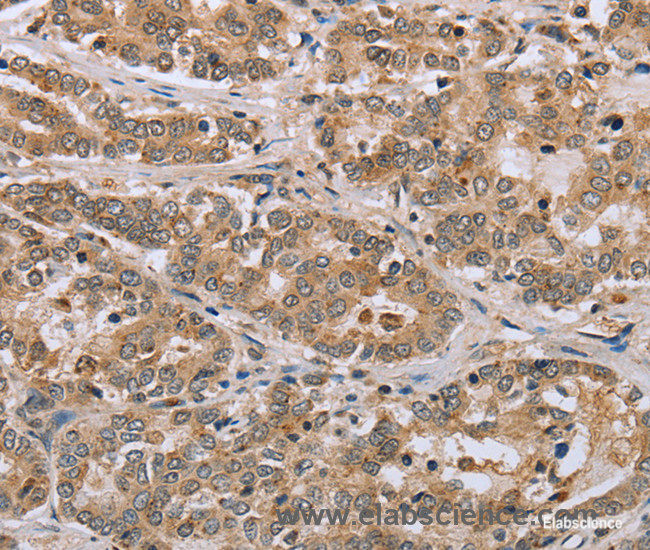 Immunohistochemistry of paraffin-embedded Human liver cancer tissue using CLEC16A Polyclonal Antibody at dilution 1:45