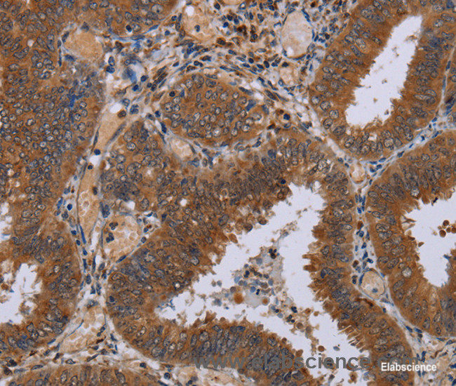 Immunohistochemistry of paraffin-embedded Human colon cancer tissue using NPTX1 Polyclonal Antibody at dilution 1:50