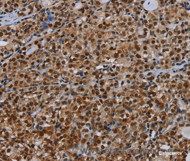Immunohistochemistry of paraffin-embedded Human thyroid cancer tissue using DCAF6 Polyclonal Antibody at dilution 1:30