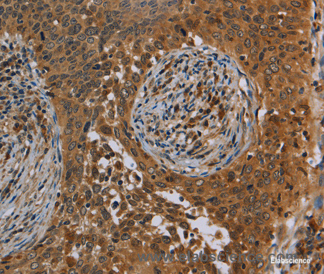 Immunohistochemistry of paraffin-embedded Human cervical cancer tissue using OSM Polyclonal Antibody at dilution 1:40