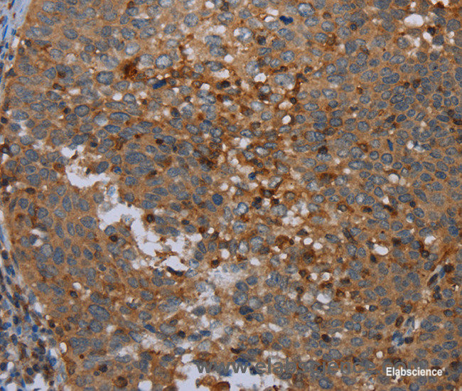 Immunohistochemistry of paraffin-embedded Human cervical cancer tissue using OTOR Polyclonal Antibody at dilution 1:30