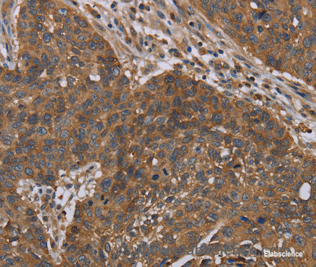 Immunohistochemistry of paraffin-embedded Human lung cancer tissue using OXTR Polyclonal Antibody at dilution 1:40