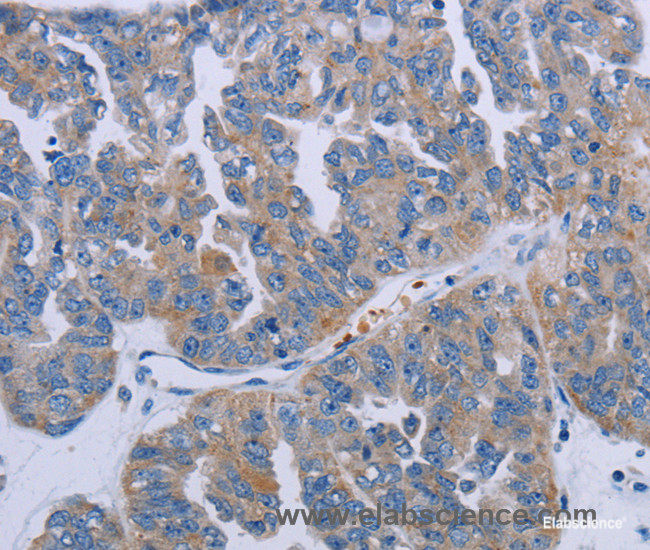 Immunohistochemistry of paraffin-embedded Human ovarian cancer tissue using P2RY2 Polyclonal Antibody at dilution of 1:40