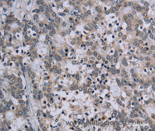 Immunohistochemistry of paraffin-embedded Human liver cancer tissue using TP53AIP1 Polyclonal Antibody at dilution 1:50