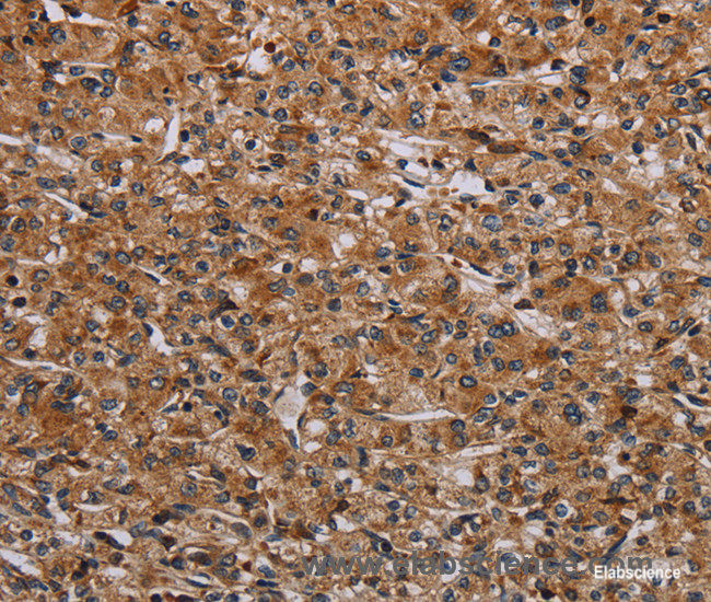 Immunohistochemistry of paraffin-embedded Human prostate cancer tissue using p70 S6 kinase beta Polyclonal Antibody at dilution 1:40