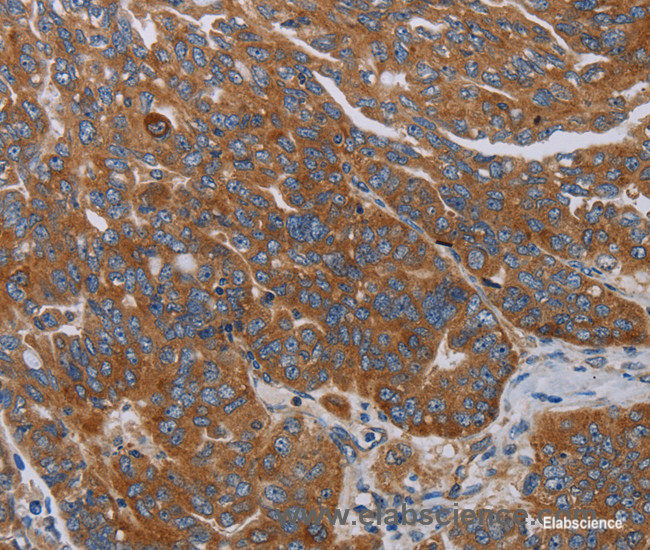 Immunohistochemistry of paraffin-embedded Human ovarian cancer tissue using PARP10 Polyclonal Antibody at dilution 1:30