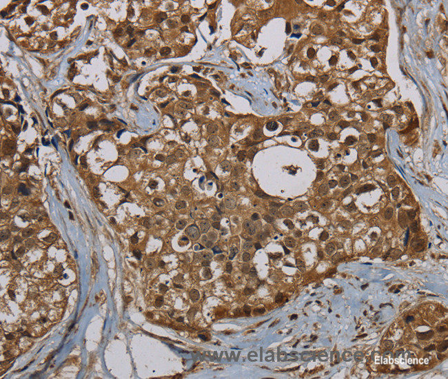 Immunohistochemistry of paraffin-embedded Human breast cancer tissue using PNN Polyclonal Antibody at dilution 1:50