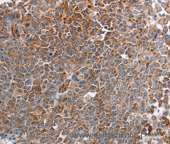 Immunohistochemistry of paraffin-embedded Human ovarian cancer tissue using PLXNA2 Polyclonal Antibody at dilution 1:40
