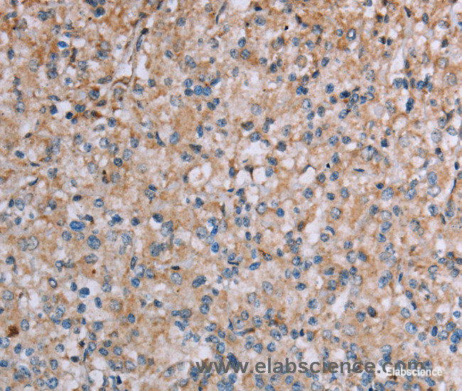 Immunohistochemistry of paraffin-embedded Human prostate cancer tissue using PLXNA4 Polyclonal Antibody at dilution 1:50