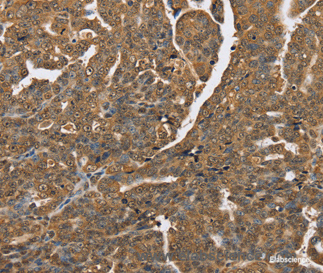 Immunohistochemistry of paraffin-embedded Human cervical cancer tissue using PTPN20 Polyclonal Antibody at dilution 1:40