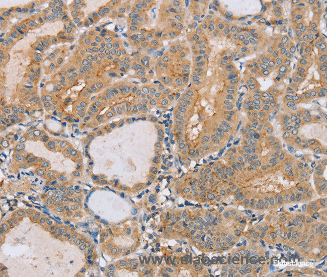 Immunohistochemistry of paraffin-embedded Human thyroid cancer tissue using PTPN4 Polyclonal Antibody at dilution 1:40