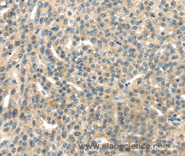 Immunohistochemistry of paraffin-embedded Human esophagus cancer tissue using RASA2 Polyclonal Antibody at dilution 1:45