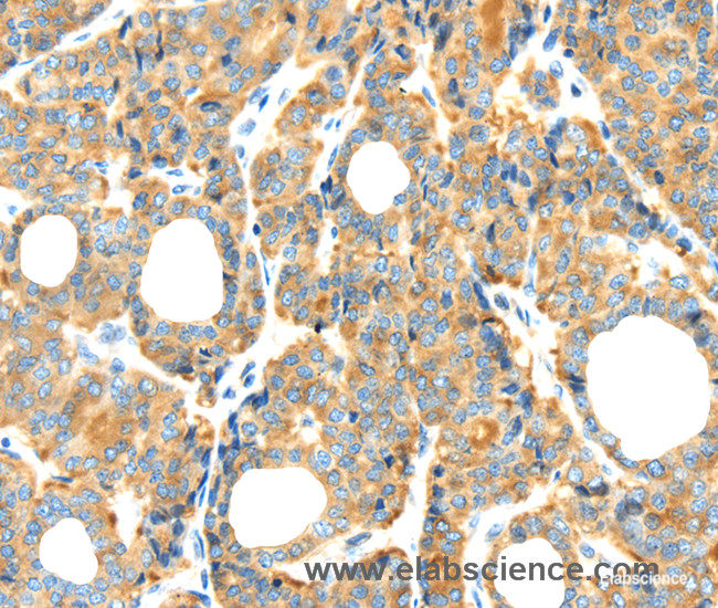 Immunohistochemistry of paraffin-embedded Human thyroid cancer tissue using RIPK4 Polyclonal Antibody at dilution 1:40