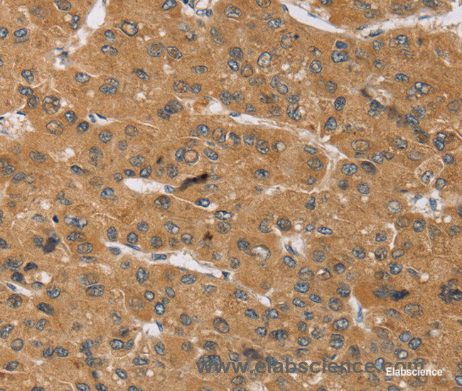 Immunohistochemistry of paraffin-embedded Human liver cancer tissue using KCNJ15 Polyclonal Antibody at dilution 1:40