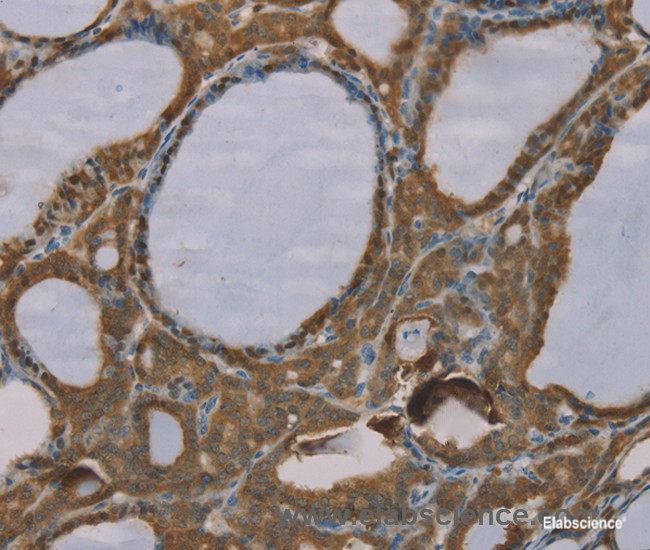 Immunohistochemistry of paraffin-embedded Human thyroid cancer tissue using S100A6 Polyclonal Antibody at dilution 1:35