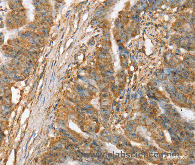 Immunohistochemistry of paraffin-embedded Human esophagus cancer tissue using SLC41A2 Polyclonal Antibody at dilution 1:45