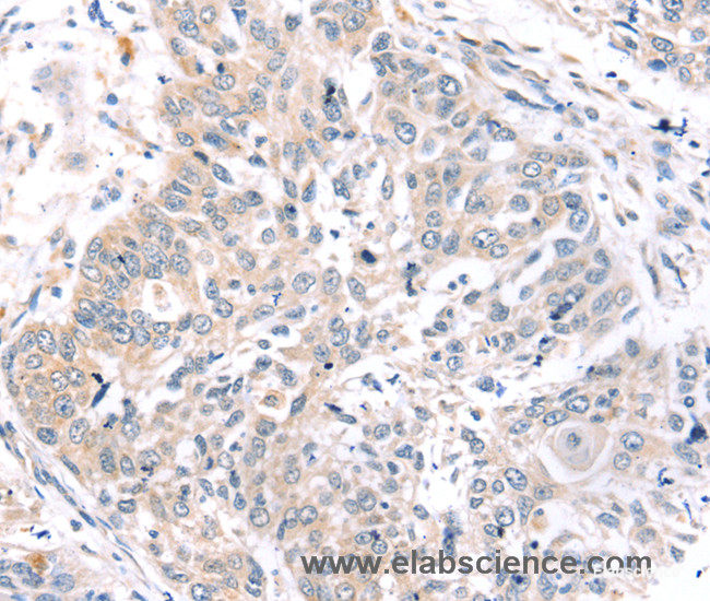 Immunohistochemistry of paraffin-embedded Human lung cancer tissue using ROR1 Polyclonal Antibody at dilution 1:45