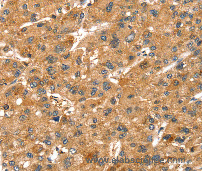 Immunohistochemistry of paraffin-embedded Human liver cancer tissue using SPTAN1 Polyclonal Antibody at dilution 1:40