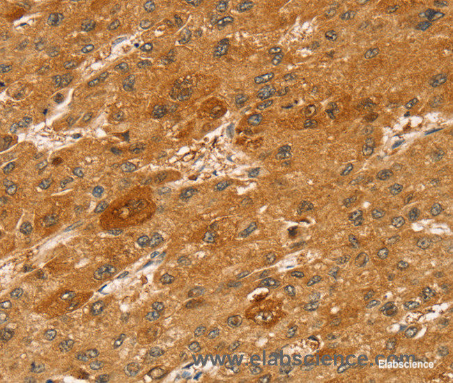 Immunohistochemistry of paraffin-embedded Human liver cancer tissue using STX2 Polyclonal Antibody at dilution 1:50
