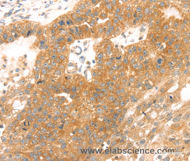 Immunohistochemistry of paraffin-embedded Human breast cancer tissue using TMEFF2 Polyclonal Antibody at dilution 1:35
