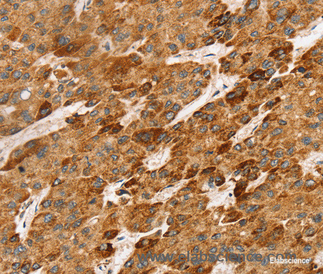 Immunohistochemistry of paraffin-embedded Human liver cancer tissue using LTB Polyclonal Antibody at dilution 1:45