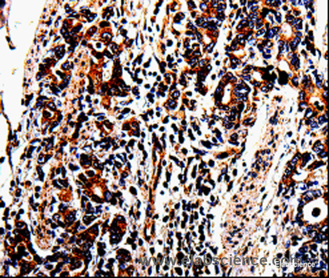 Immunohistochemistry of paraffin-embedded Human stomach cancer tissue using ACSBG2 Polyclonal Antibody at dilution 1:60
