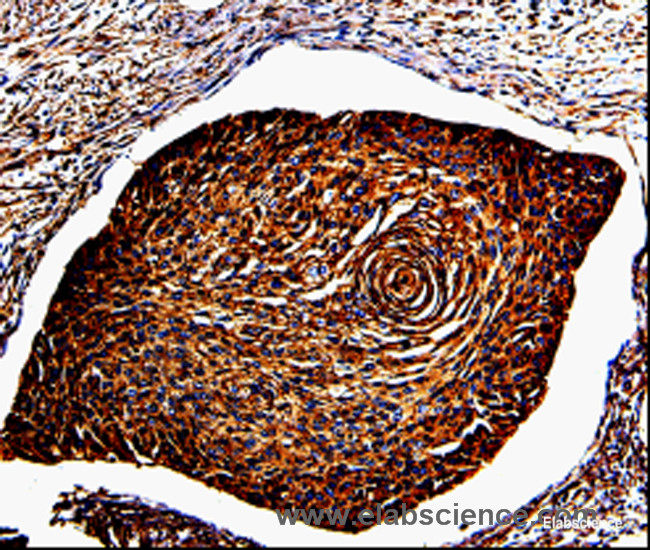 Immunohistochemistry of paraffin-embedded Human cervical cancer tissue using ANXA7 Polyclonal Antibody at dilution 1:150