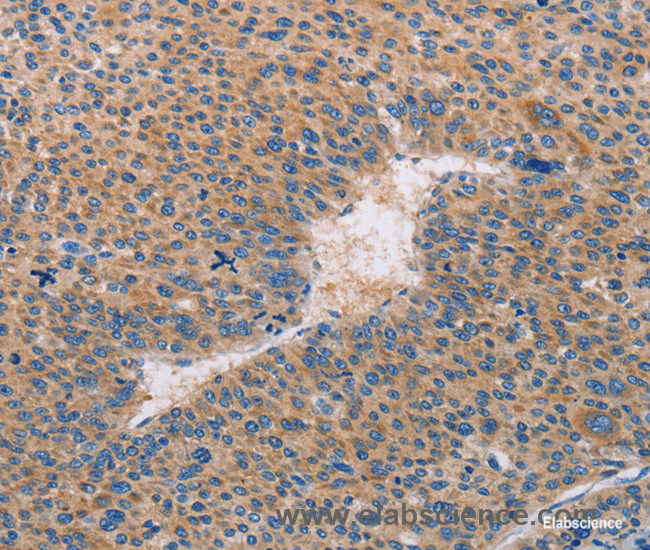 Immunohistochemistry of paraffin-embedded Human liver cancer tissue using CASP10 Polyclonal Antibody at dilution 1:30