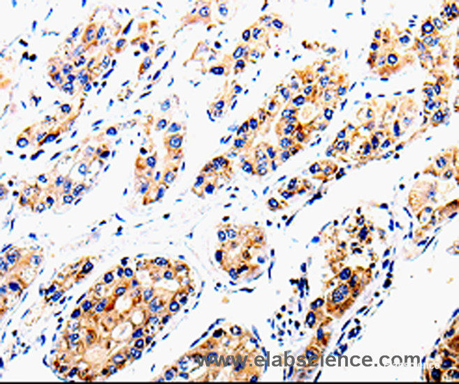 Immunohistochemistry of paraffin-embedded Human liver cancer tissue using COX16 Polyclonal Antibody at dilution 1:50