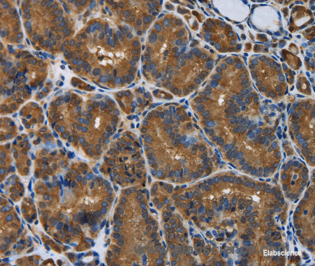 Immunohistochemistry of paraffin-embedded Human thyroid cancer tissue using SNCG Polyclonal Antibody at dilution 1:50