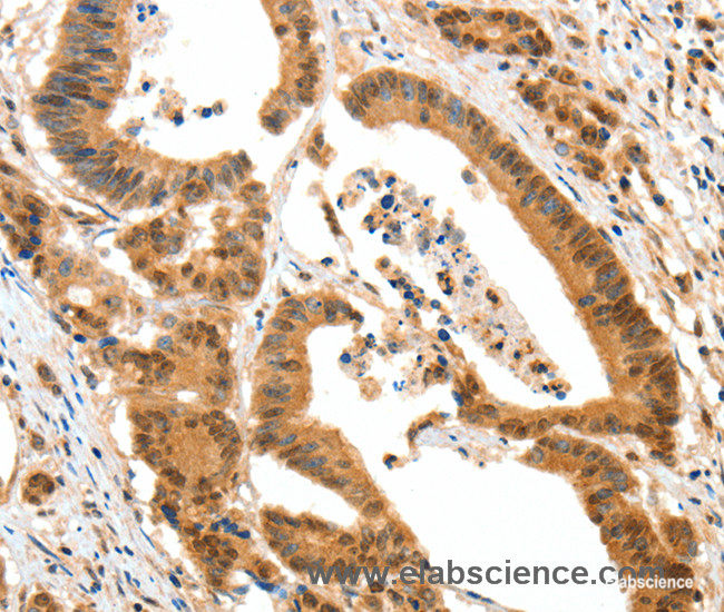 Immunohistochemistry of paraffin-embedded Human colon cancer tissue using HTR3A Polyclonal Antibody at dilution 1:50