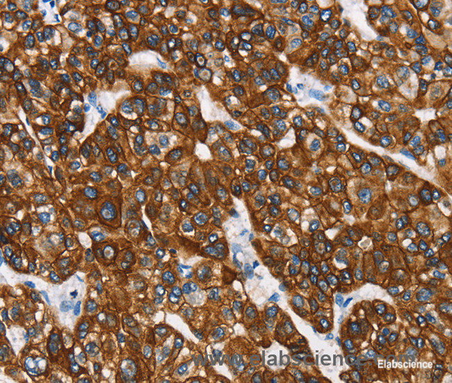 Immunohistochemistry of paraffin-embedded Human liver cancer tissue using CK-8 Polyclonal Antibody at dilution 1:40