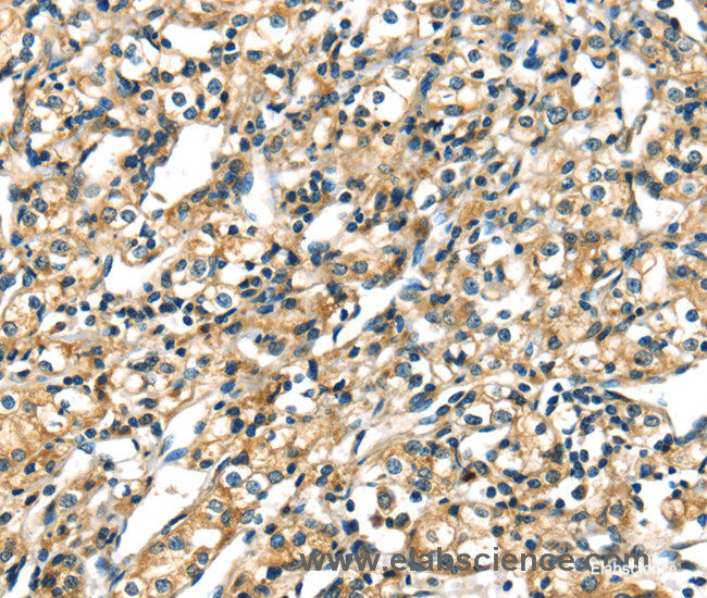 Immunohistochemistry of paraffin-embedded Human prostate cancer tissue using CK-17 Polyclonal Antibody at dilution 1:40