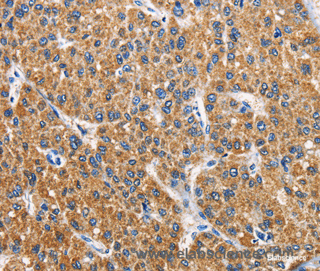 Immunohistochemistry of paraffin-embedded Human liver cancer tissue using APLNR Polyclonal Antibody at dilution 1:40