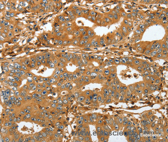 Immunohistochemistry of paraffin-embedded Human gastric cancer tissue using RAP1A Polyclonal Antibody at dilution 1:45