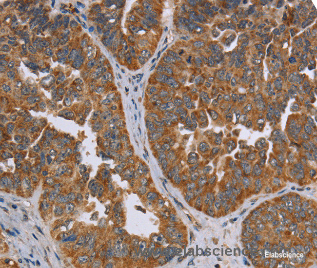 Immunohistochemistry of paraffin-embedded Human ovarian cancer tissue using ADAMTS15 Polyclonal Antibody at dilution 1:60