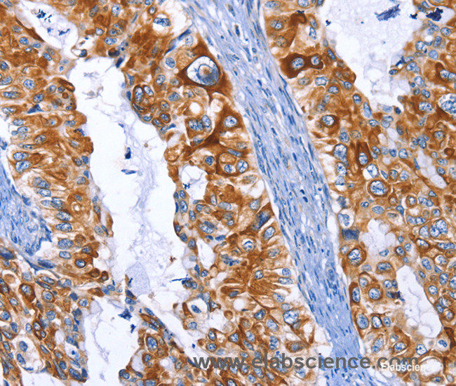 Immunohistochemistry of paraffin-embedded Human cervical cancer tissue using ARRB1 Polyclonal Antibody at dilution 1:50
