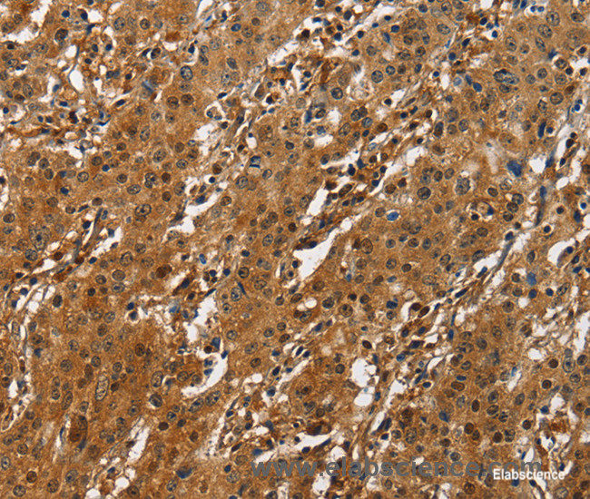 Immunohistochemistry of paraffin-embedded Human gasrtic cancer tissue using CREB2 Polyclonal Antibody at dilution 1:50