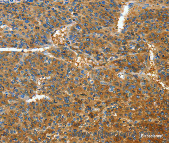 Immunohistochemistry of paraffin-embedded Human liver cancer tissue using TNFSF13B Polyclonal Antibody at dilution 1:30